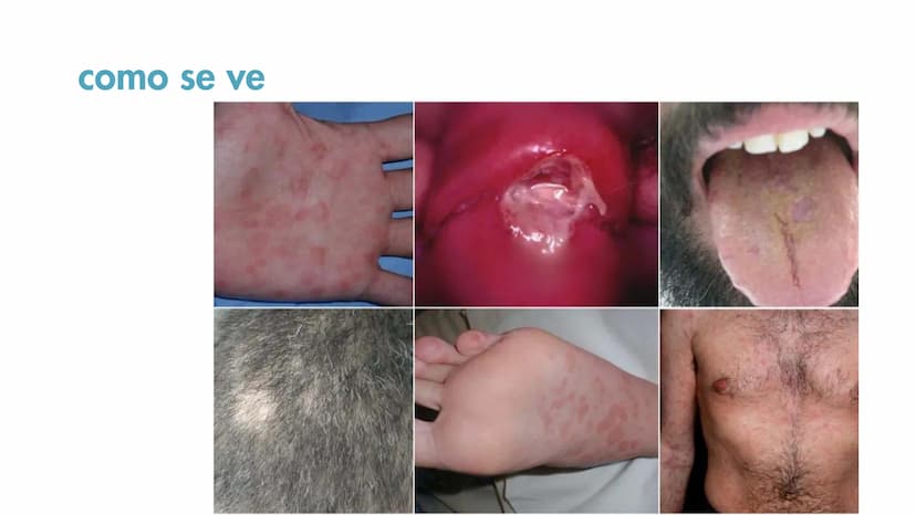 ¿Qué es la sifilis?
La sífilis es una infección de transmisión sexual, que
puede causar graves problemas de salud si no se trata.
La infecci