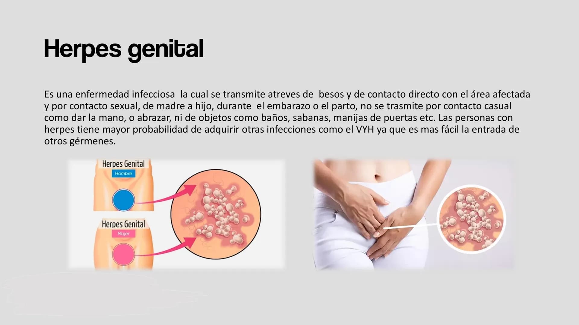 HERPES GENITAL Herpes genital
Es una enfermedad infecciosa la cual se transmite atreves de besos y de contacto directo con el área afectada
