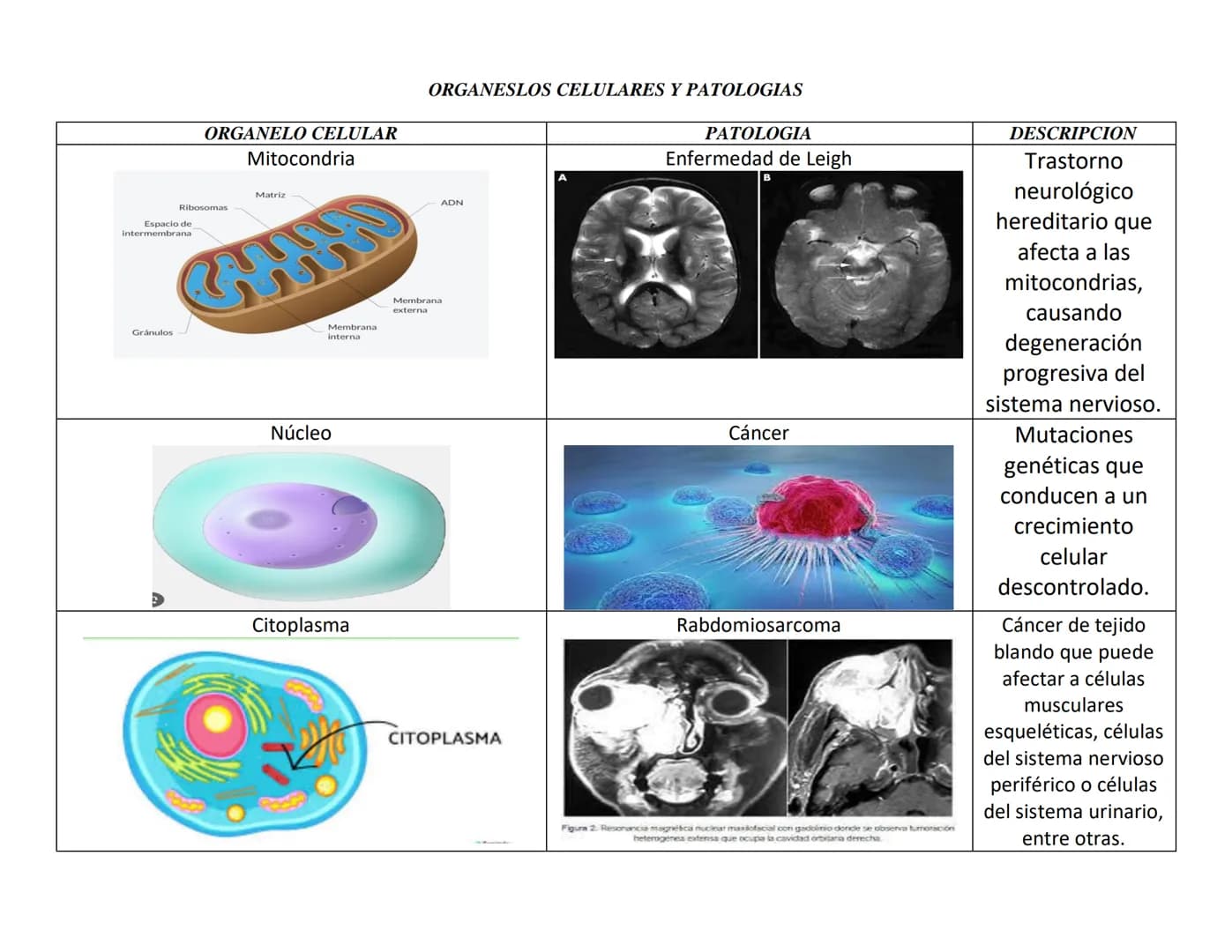 ORGANELO CELULAR
Mitocondria
ORGANESLOS CELULARES Y PATOLOGIAS
PATOLOGIA
Enfermedad de Leigh
Ribosomas
Espacio de
intermembrana
Matriz
Gránu