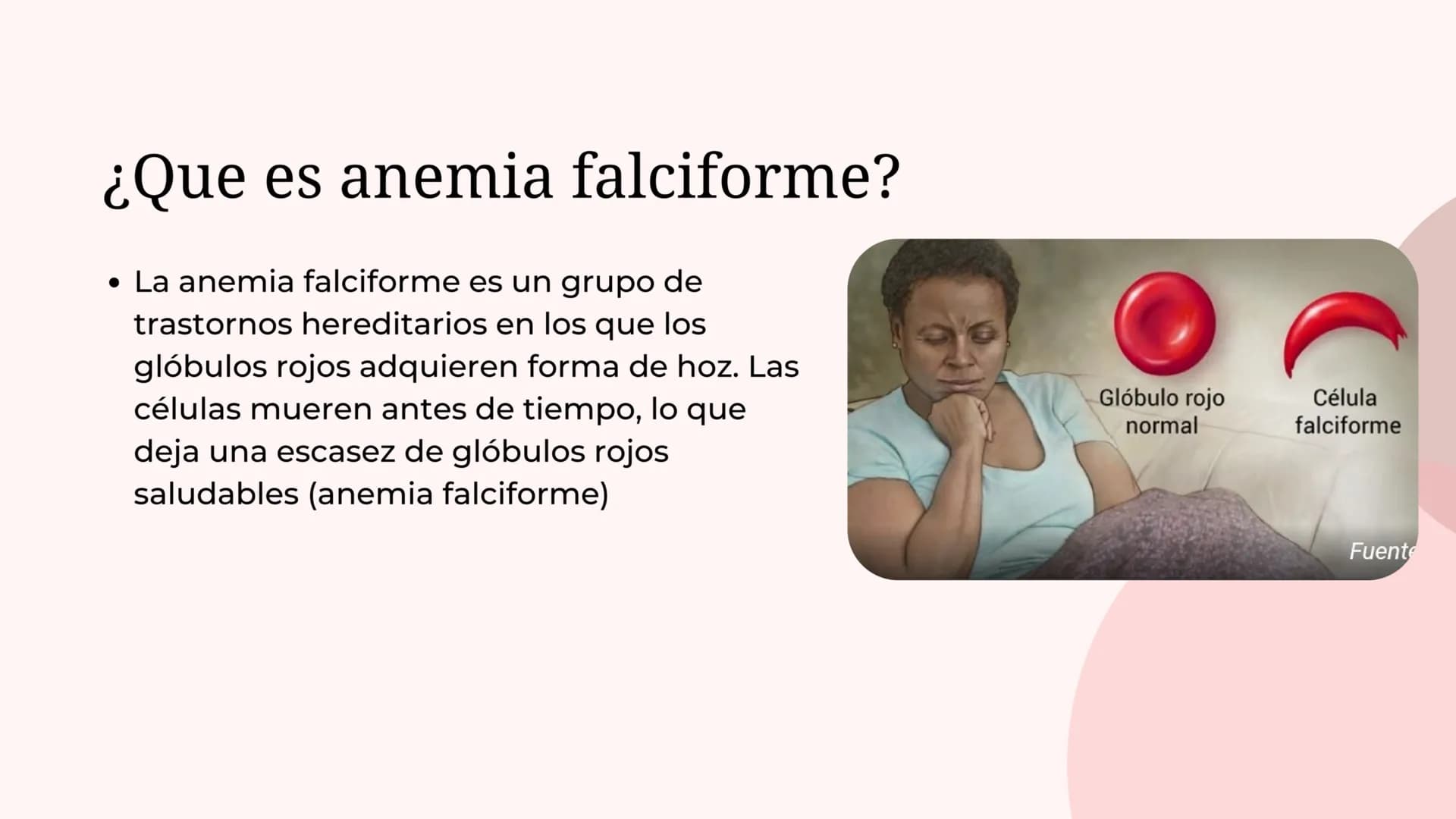 ¿Que es anemia falciforme?
• La anemia falciforme es un grupo de
trastornos hereditarios en los que los
glóbulos rojos adquieren forma de ho