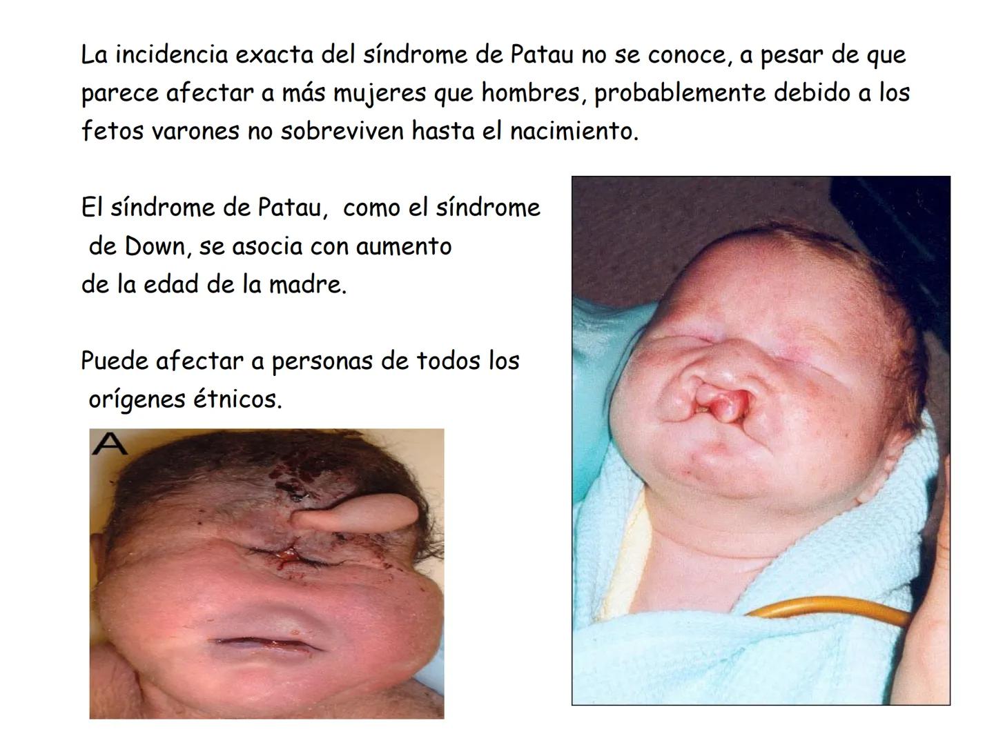 ¿Que es el Síndrome
de Patau?
El síndrome de Patau, también conocido como trisomia en
el par 13, trisomia D'o síndrome de Bartholin-Patau, e