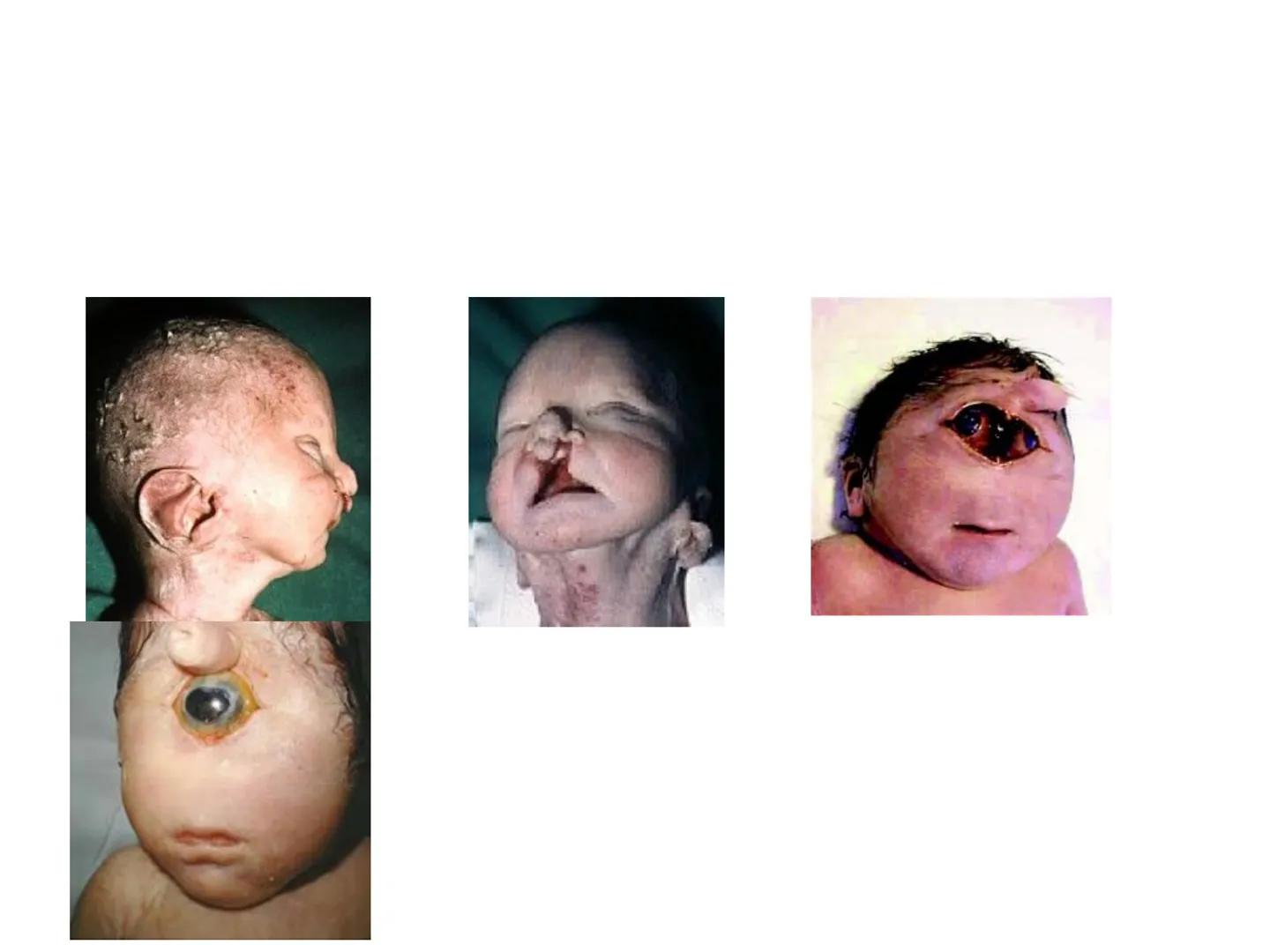 ¿Que es el Síndrome
de Patau?
El síndrome de Patau, también conocido como trisomia en
el par 13, trisomia D'o síndrome de Bartholin-Patau, e