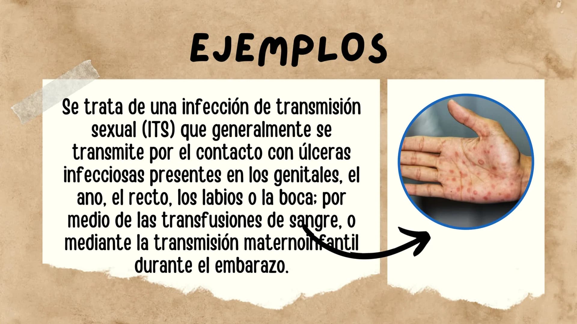 LA SIFILIS
ENFERMEDAD DE TRANSMISIÓN SEXUAL
elle CONTENIDOS
⚫ DEFINICIÓN
• EJEMPLOS
• PROBLEMA ÉTICO
•SÍNTOMAS
• CONCLUSIÓN
⚫ POSIBLE SOLUCI