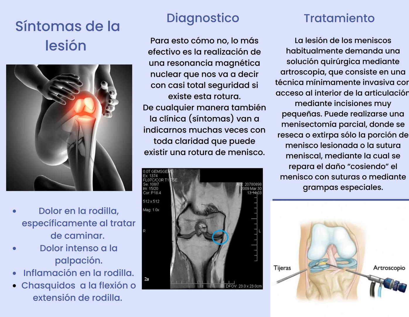 # LESION DE LOS
MENISCOS

¿Qué son los
meniscos?

Los meniscos en las rodillas
son estructuras en
fibrocartilaginosas
en
forma de cuña que p