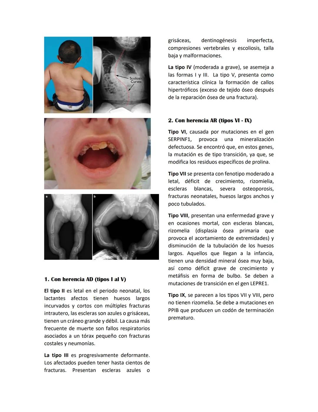 OSTEOGENESIS IMPERFECTA
Se encuentra dentro del gran grupo de las colagenopatías: Estos desordenes incluyen anomalías en
la estructura o can