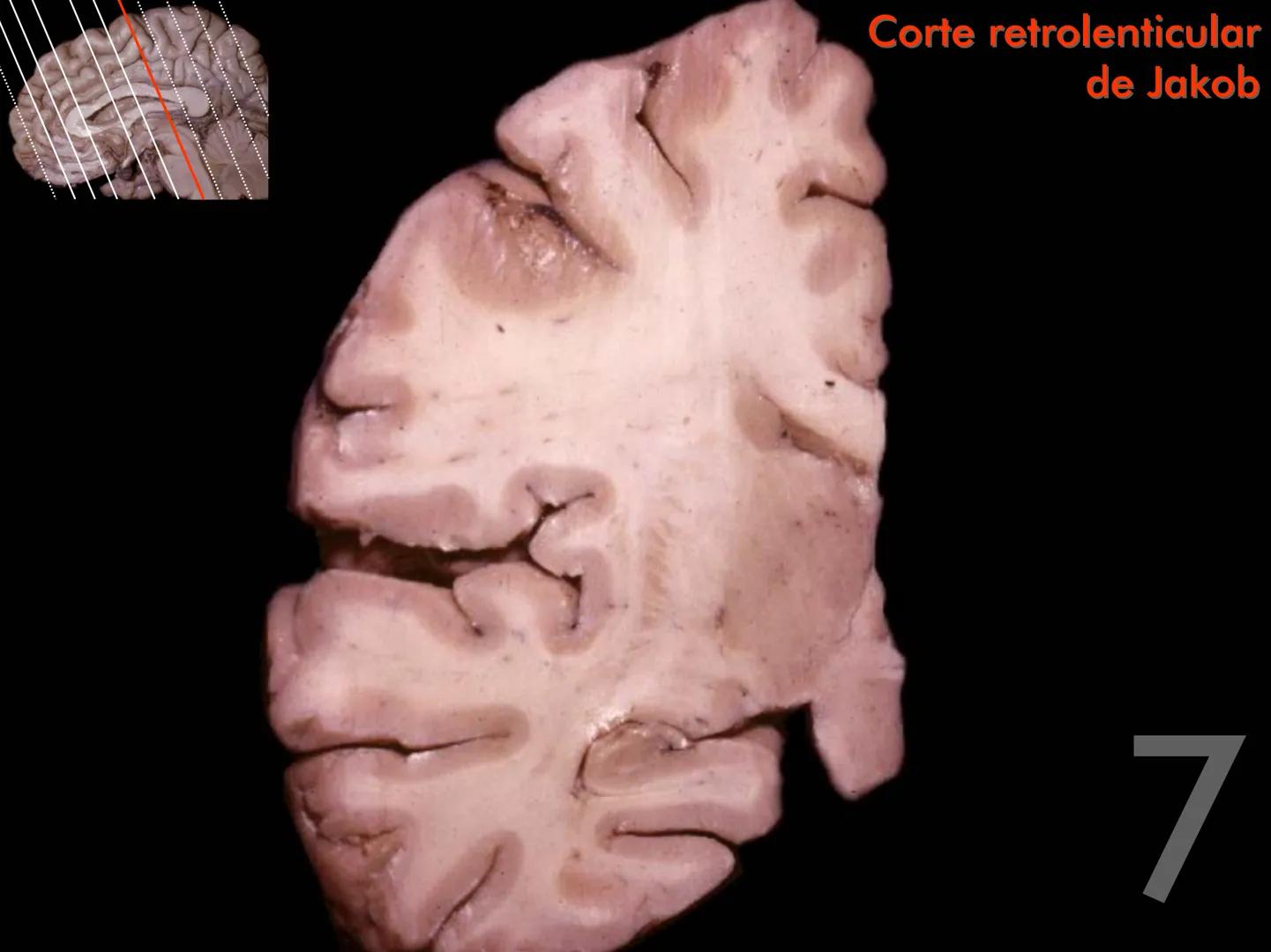 Cortes
de Cerebro
Autores:
Valeria A Forlizzi
Eduardo A Pró
Diseño:
Fernando M Forlizzi
ν.2005.α # Corte sagital medio de encéfalo # Partes