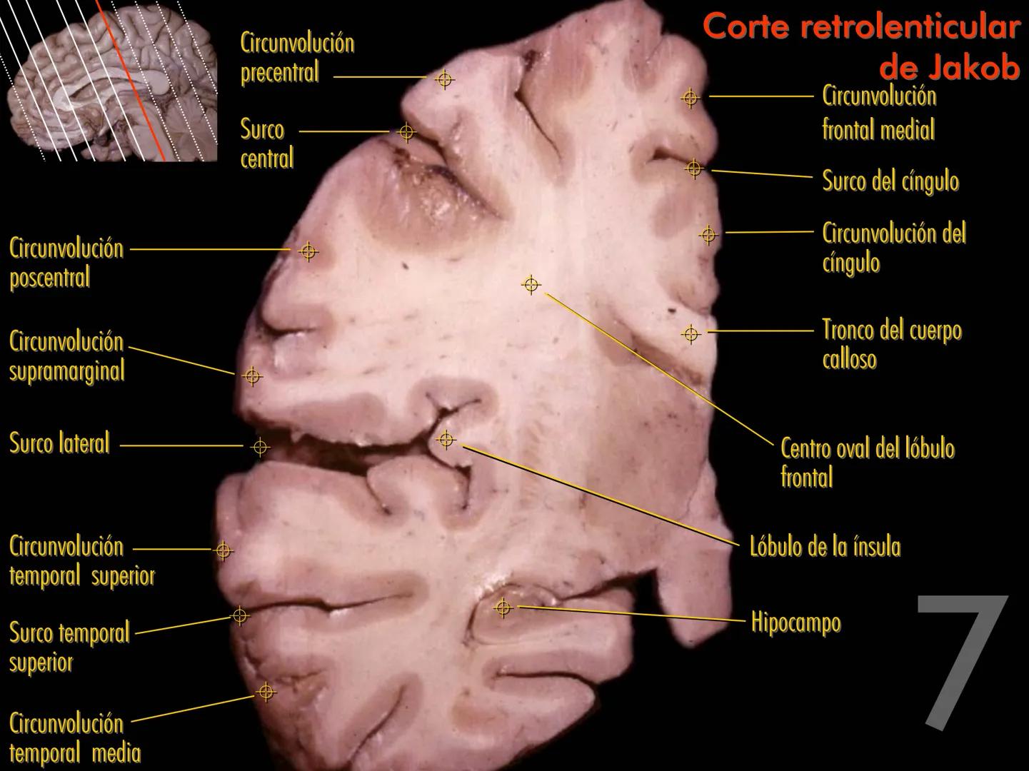 Cortes
de Cerebro
Autores:
Valeria A Forlizzi
Eduardo A Pró
Diseño:
Fernando M Forlizzi
ν.2005.α # Corte sagital medio de encéfalo # Partes