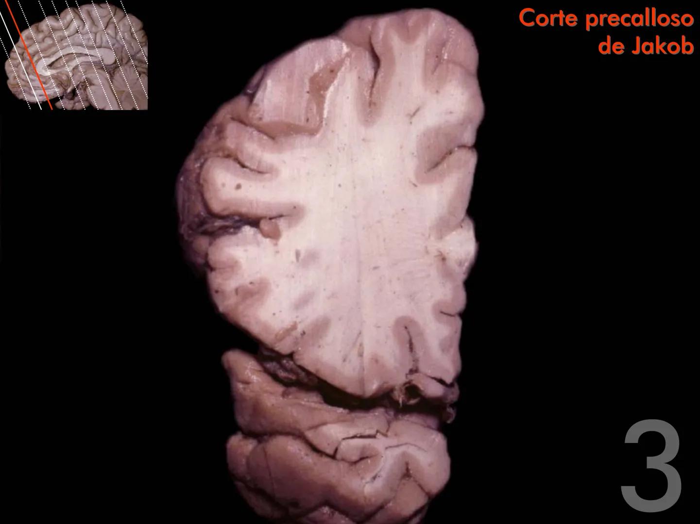 Cortes
de Cerebro
Autores:
Valeria A Forlizzi
Eduardo A Pró
Diseño:
Fernando M Forlizzi
ν.2005.α # Corte sagital medio de encéfalo # Partes