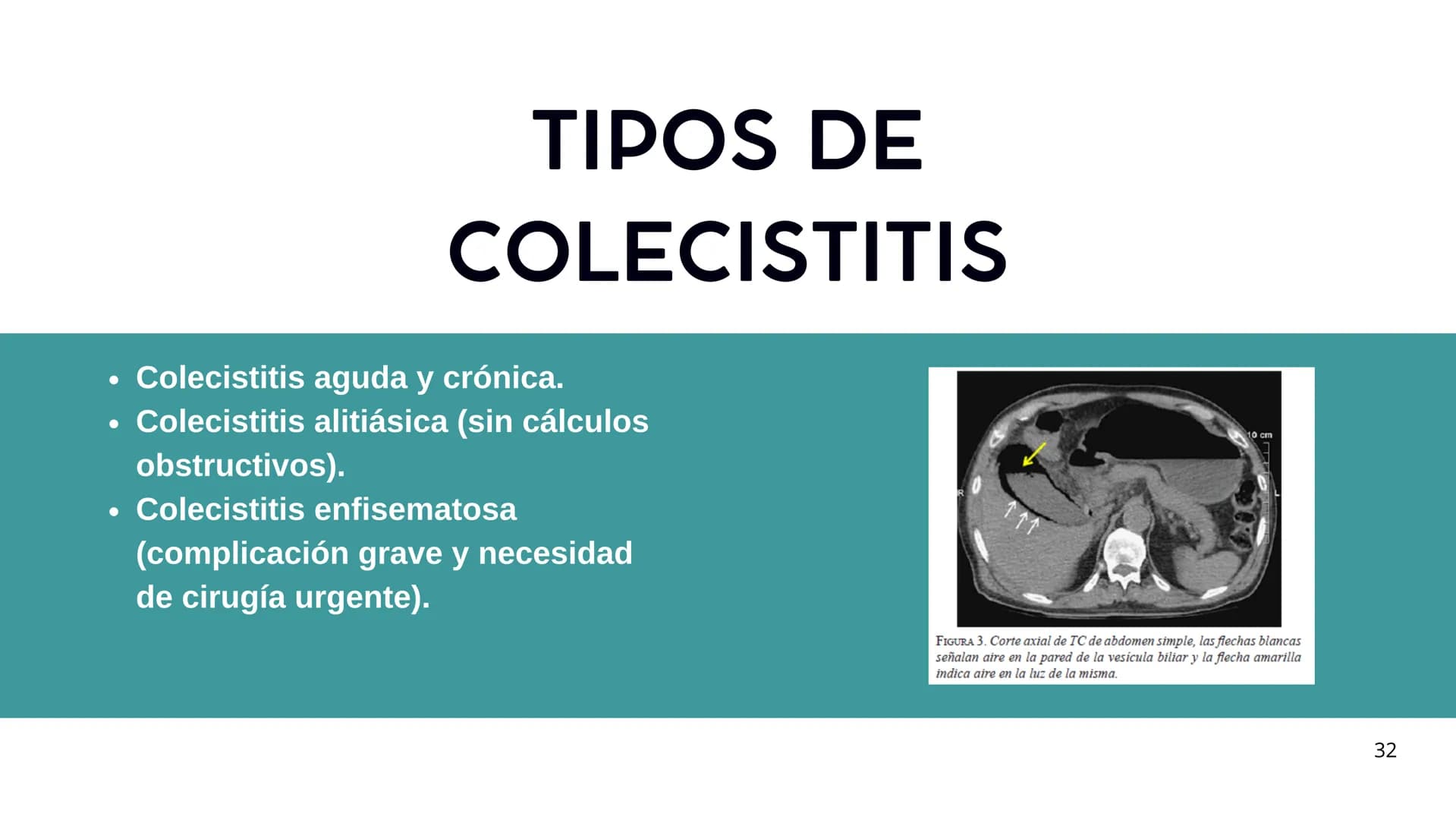 # FORMACIÓN DE LA BILIS
* Colesterol
* Electrolitos y
agua
* Sales Biliares
* Bilirrubina
* Fosfolipidos
Canal biliar
Arteri