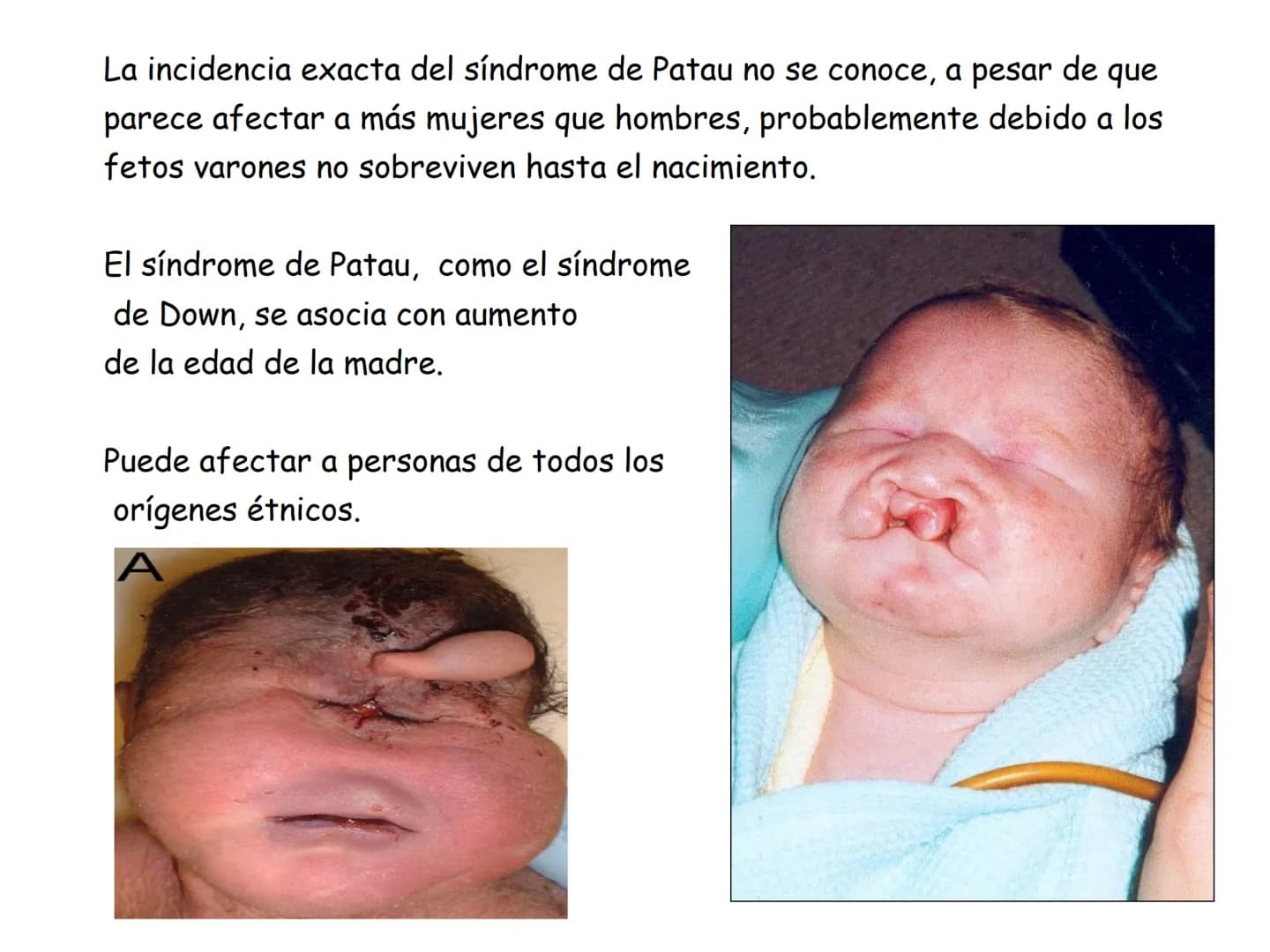 # ¿Que es el Síndrome
de Patau?
El síndrome de Patau, también conocido como trisomía en
el par 13, trisomía D' o síndrome de Bartholin-Pata