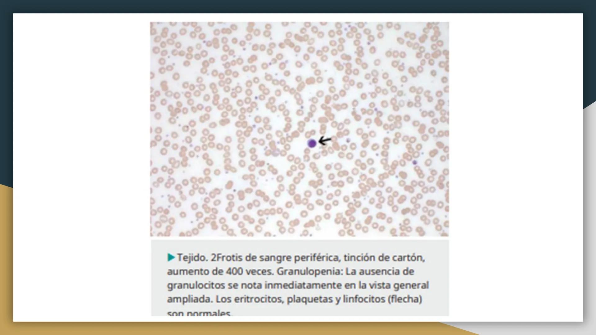 # Trastornos leucocitarios
JOSEPH JACOBO SU Leucocitosis
Recuento elevado de leucocitos por encima de 11,000 células por
mm3.
50,000 a 10