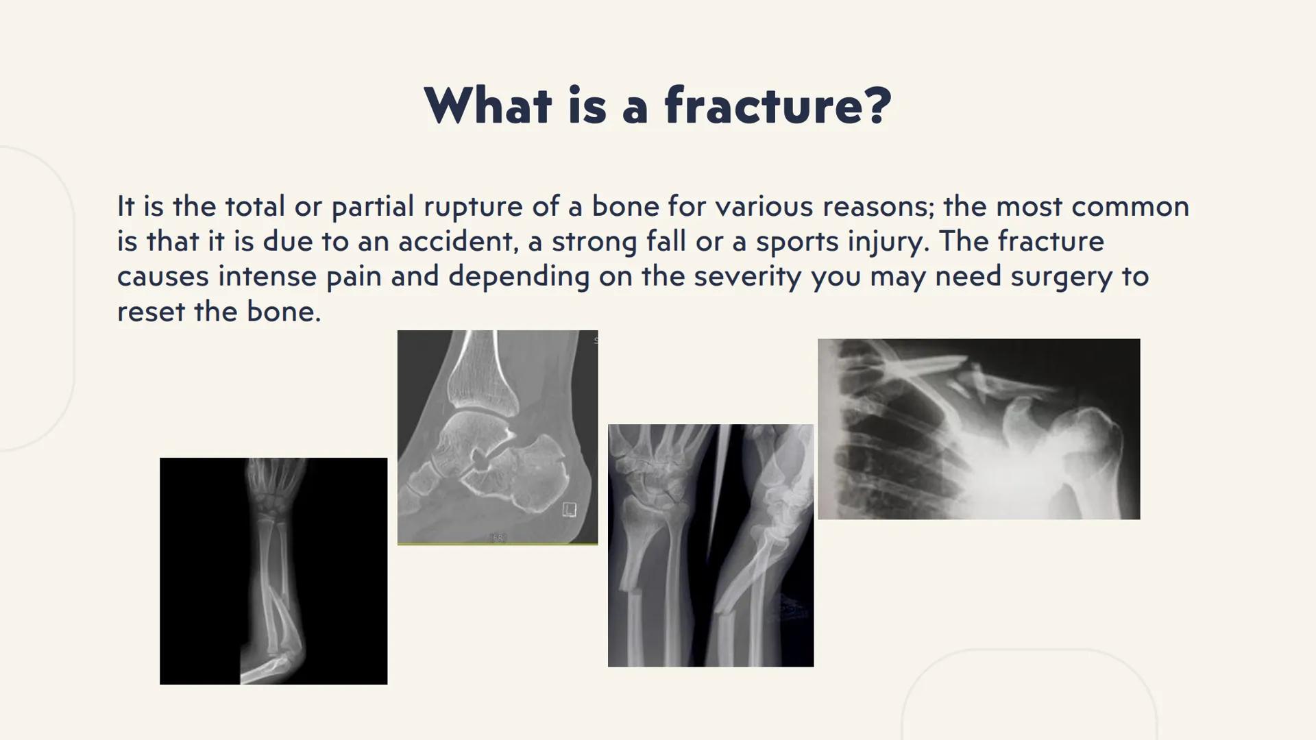 # fractures # What is a fracture?
It is the total or partial rupture of a bone for various reasons; the most common
is that it is due to an