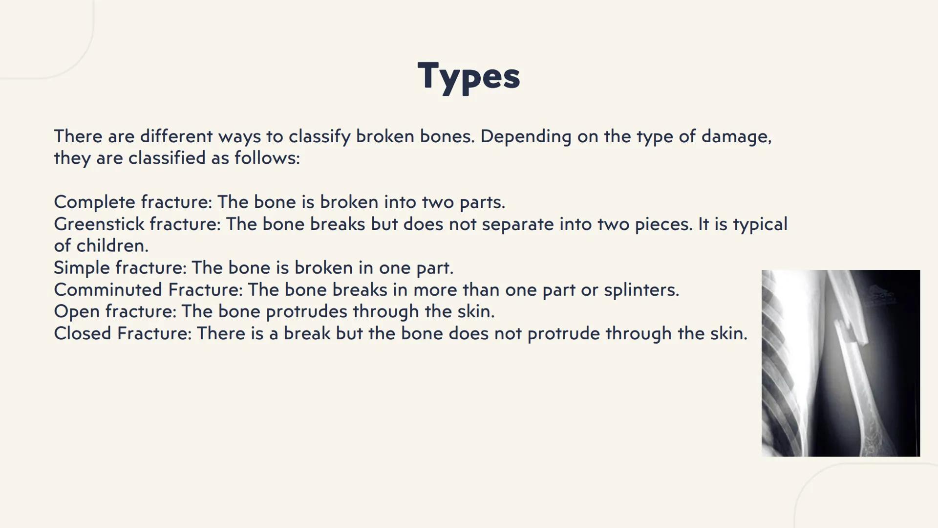 # fractures # What is a fracture?
It is the total or partial rupture of a bone for various reasons; the most common
is that it is due to an