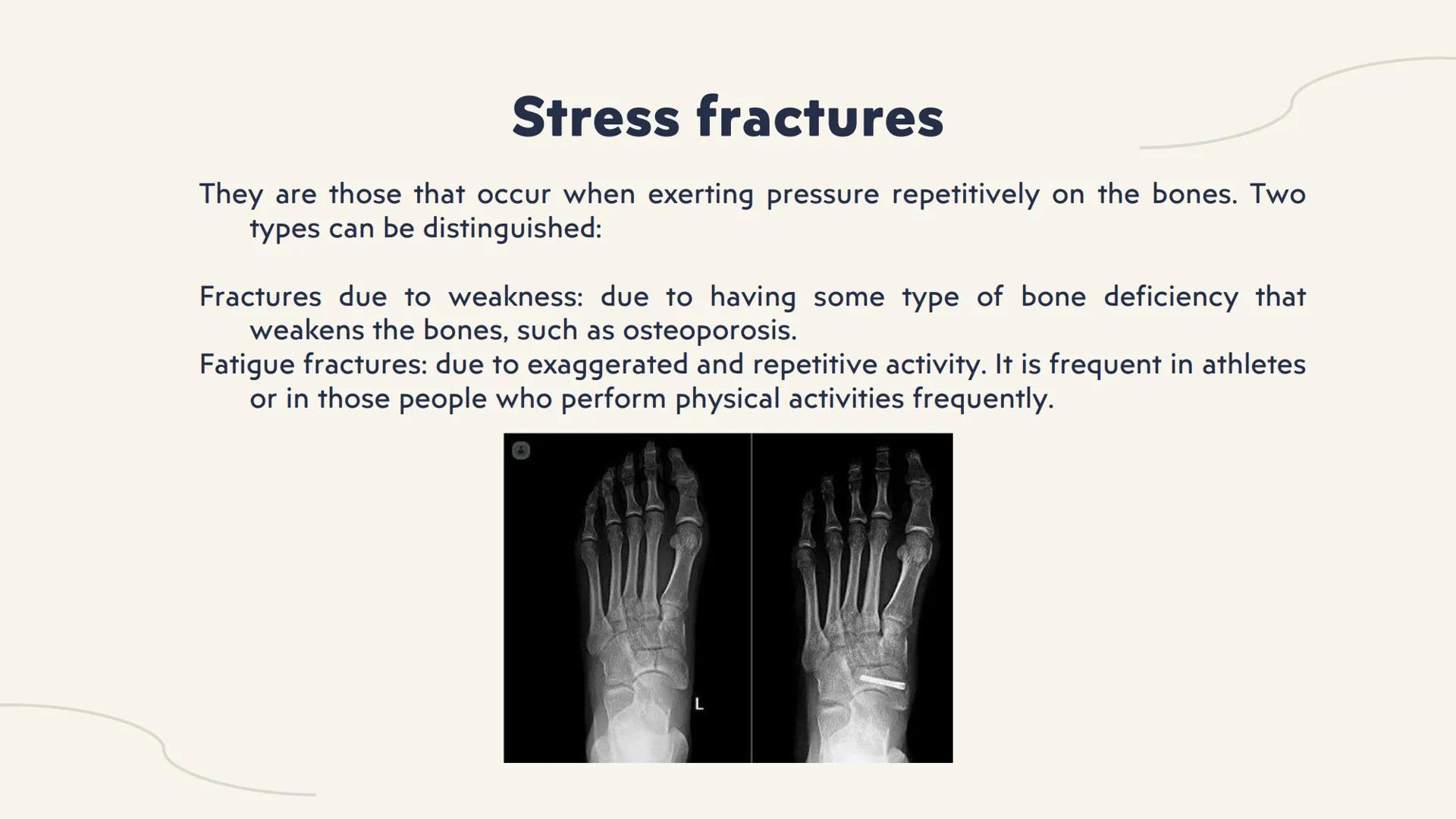 # fractures # What is a fracture?
It is the total or partial rupture of a bone for various reasons; the most common
is that it is due to an