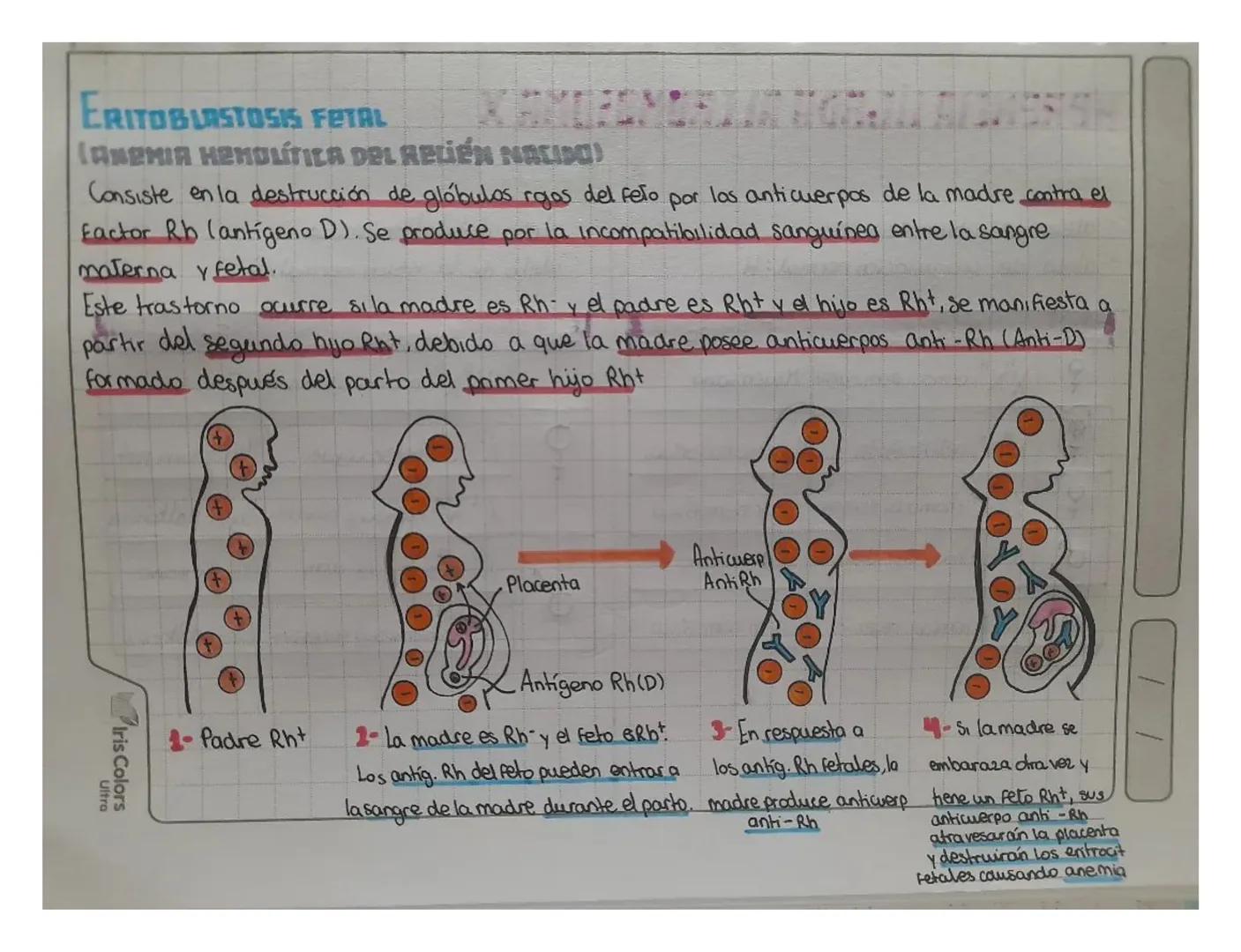 # ERITOBLASTOSIS FETAL
(ANEMIA HEMOLÍTICA DEL RELIÉN NACIDO)
Consiste en la destrucción de glóbulos rogas del feto por las anticuerpos de la