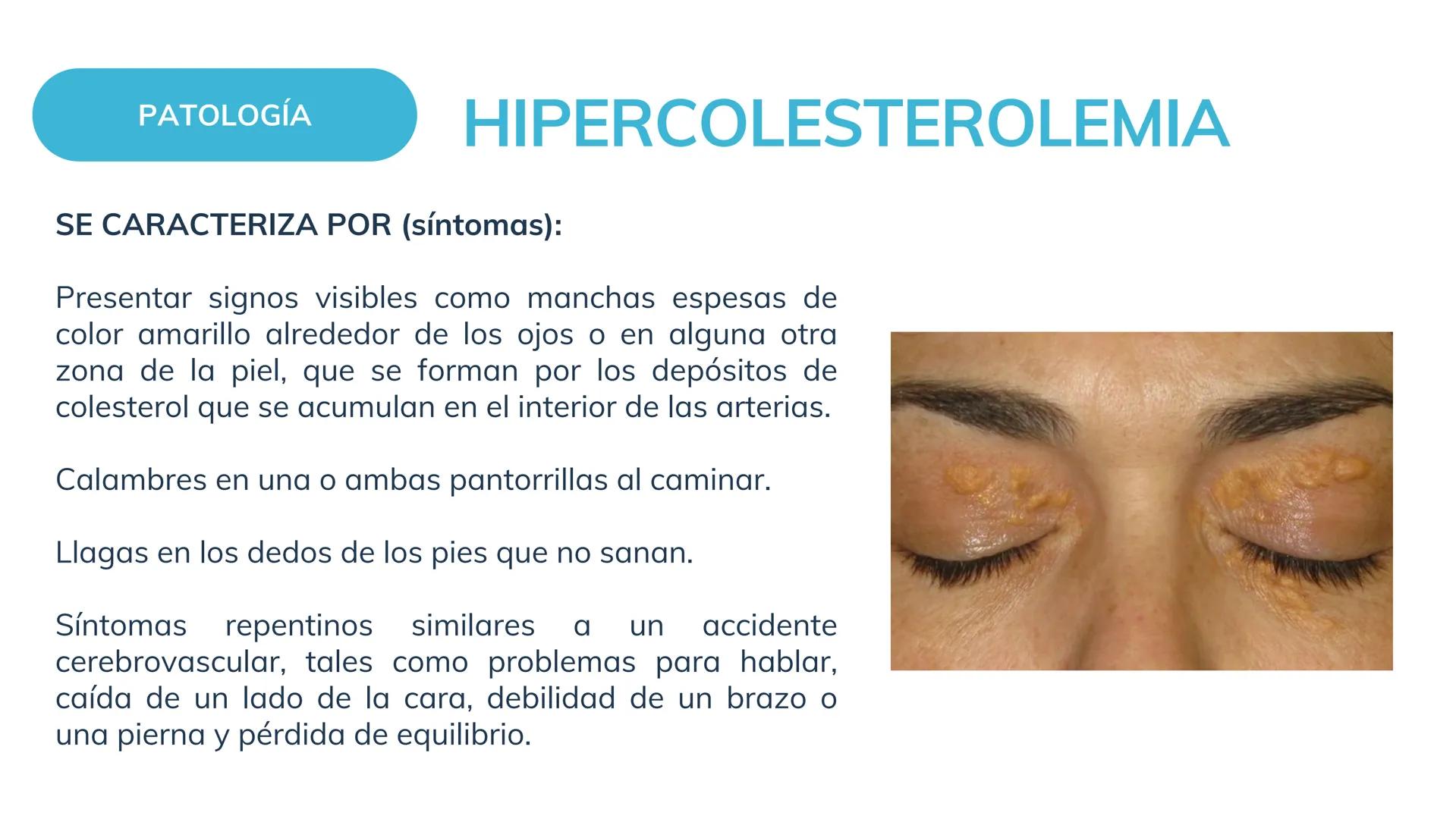 # Ejemplo de sustentación de caso clínico
# Hipercolesterolemia
Enfermería SISTEMA
COMPROMETIDO
SISTEMA CARDIOVASCULAR
El sistema cardiova